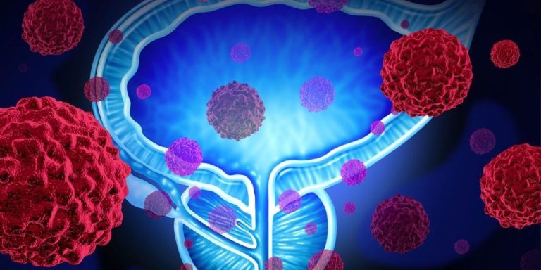 Καρκίνος του προστάτη: Τι πρέπει να γνωρίζουν όλοι οι άνδρες για τη νόσο