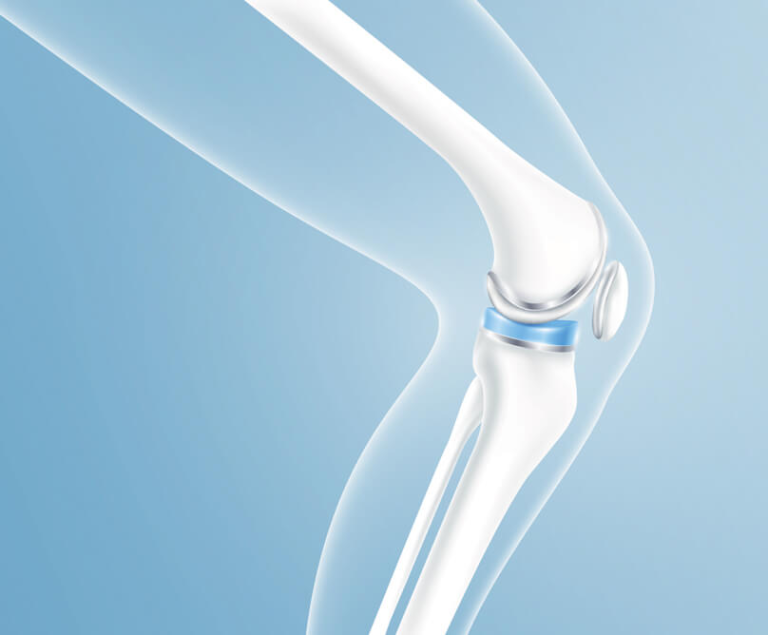 Μονοδιαμερισματική αρθροπλαστική γόνατος: Πώς ανακουφίζει από τον πόνο