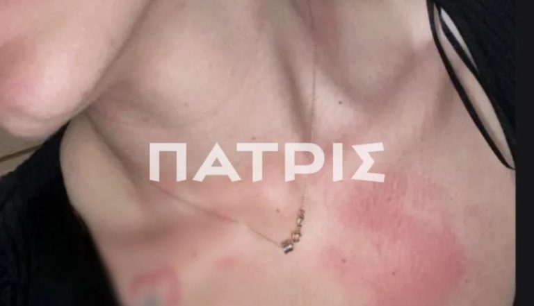 Σοκάρουν τα σημάδια από τον εφιάλτη στα χέρια του πρώην συζύγου της! (PHOTOS)