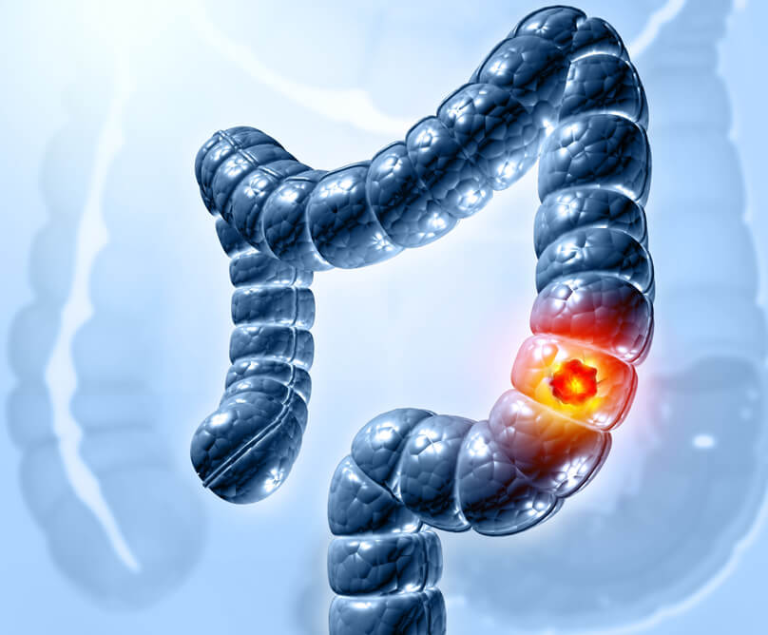 Καρκίνος του παχέος εντέρου: Ποια συμπτώματα προειδοποιούν