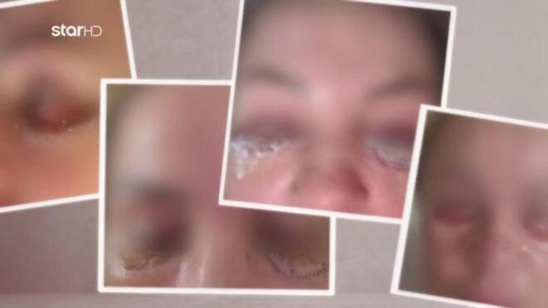 Πήγε για βλεφαροπλαστική και έχασε μέρος της όρασής της! (VIDEO)